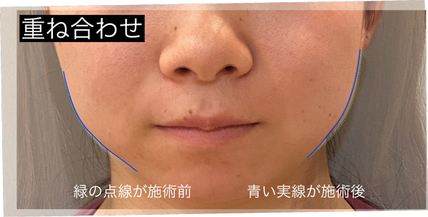 重ね合わせ(輪郭の変化の比較)